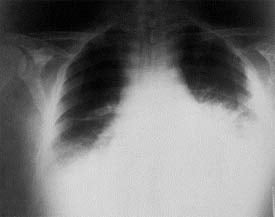 X-ray of lungs infected by inhalation anthrax